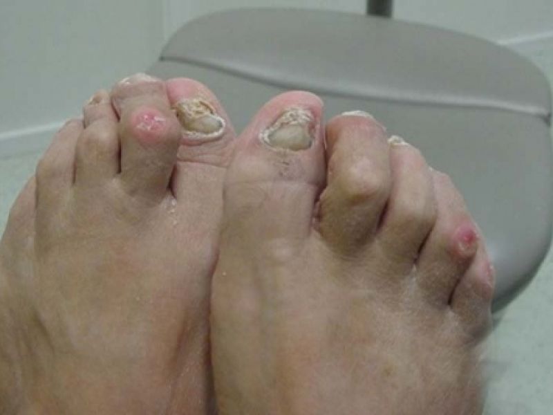 Onicomicosis